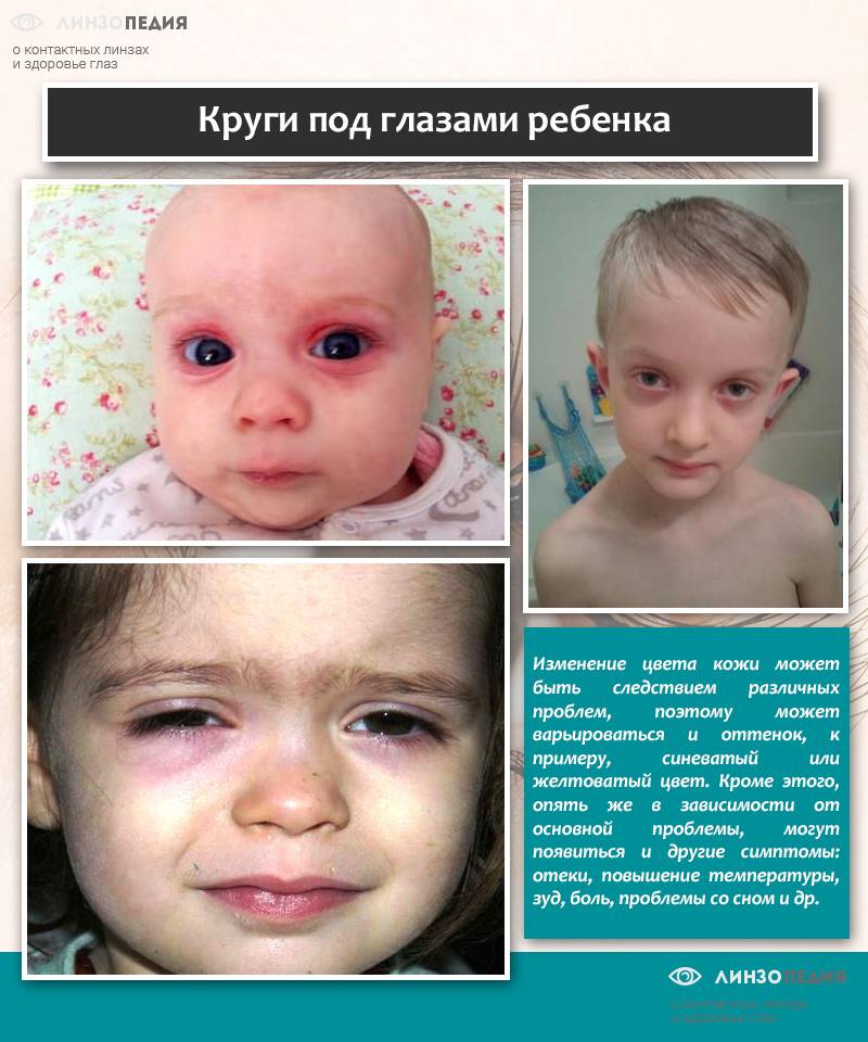 Доктор комаровский о синяках под глазами у ребенка