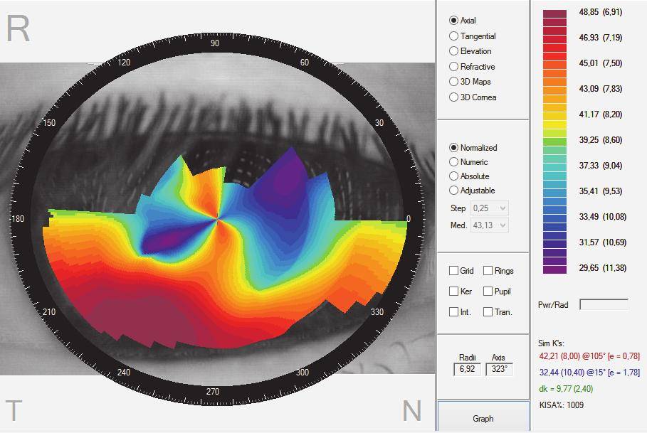 Компьютерная кератотопография: лазерная технология на страже зрения