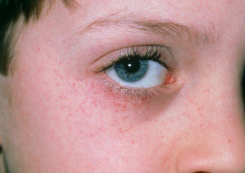 У ребенка красные сосуды в глазах и белки – причины