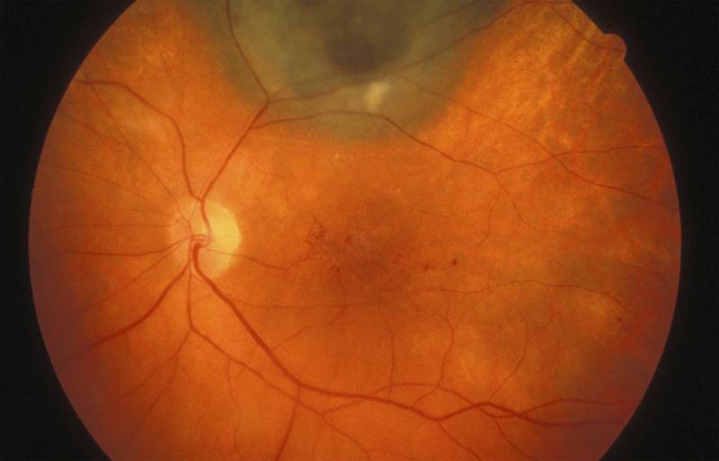 Макулодистрофия сетчатки глаза: симптомы, диагностика, лечение — глаза эксперт