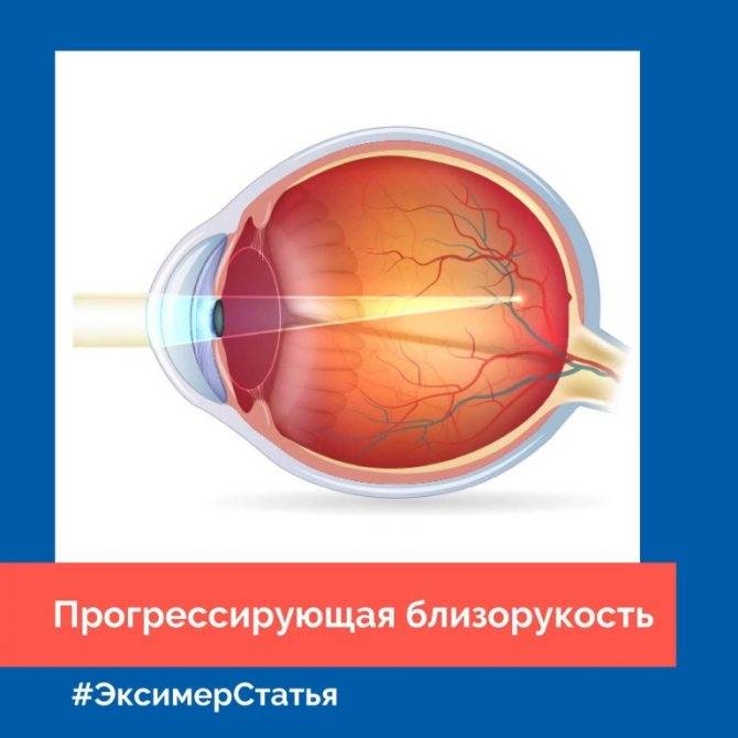 Что такое близорукость (миопия) глаз: лечение и профилактика