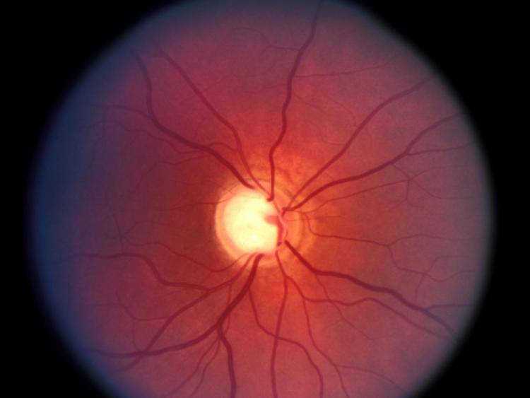 Дзн - застойный диск зрительного нерва в офтальмологии: причины и лечение, симптомы, побледнение и отек