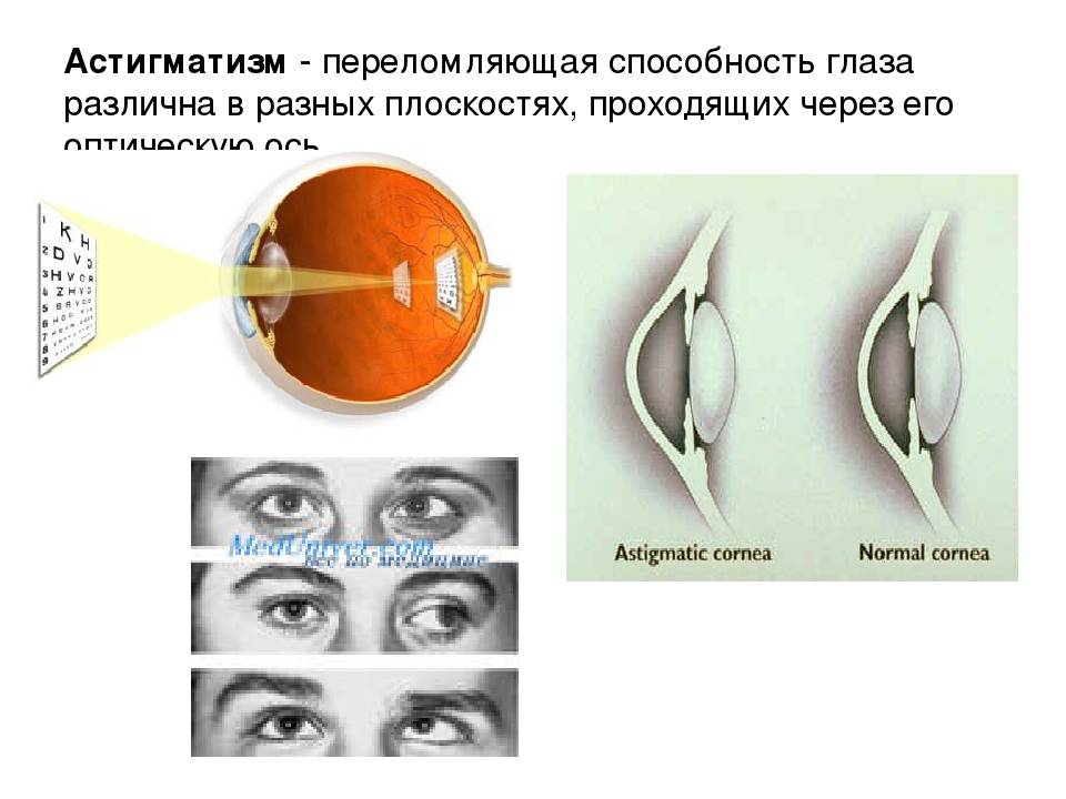 Врожденный астигматизм — причины, лечение и степени заболевания — глаза эксперт