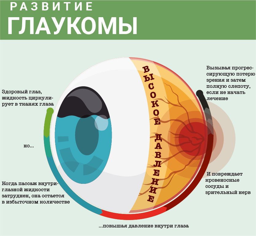 Терминальная глаукома: причины, диагностика и лечение — глаза эксперт