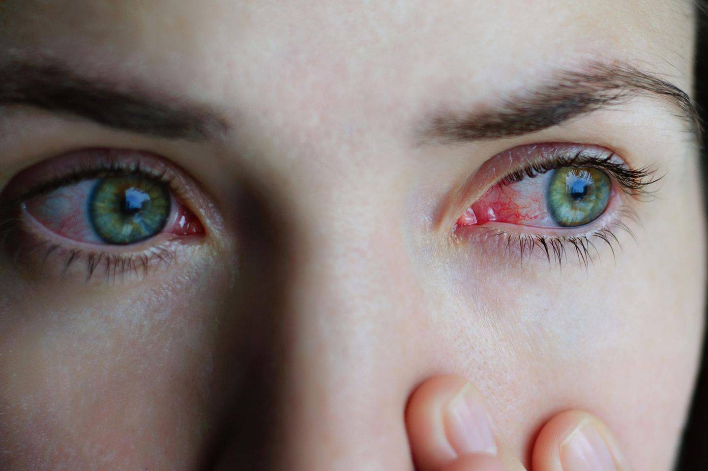 Что делать если глаз красный и болит от линз