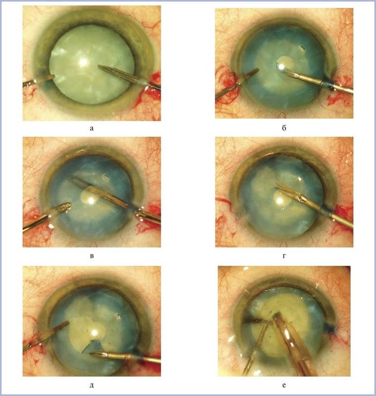 Факоэмульсификация катаракты: что это такое, как лечат лазером и ультразвуком, операция с имплантацией иол