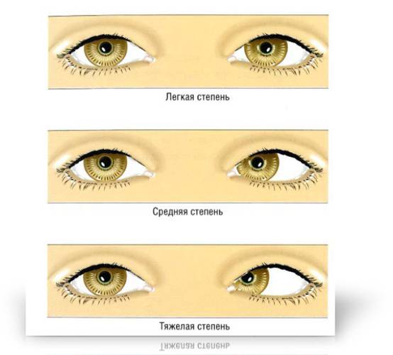Что это такое - амблиопия у детей: причины и степени заболевания глаз