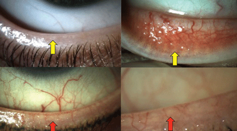 Воспаление мейбомиевой железы века глаза лечение