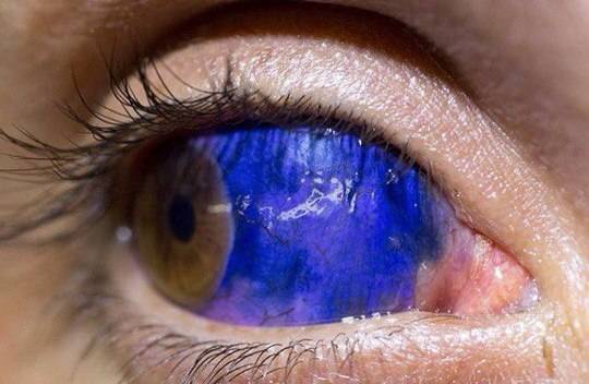 Синие белки глаз причины. из-за чего бывают голубыми белки глаз? симптомы, диагностика и лечение