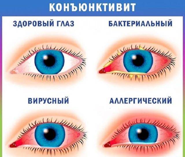 Воспаление глаз - лечение покраснения и воспалительных заболеваний в домашних условиях