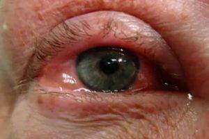 Рак глаза первые симптомы и признаки болезни