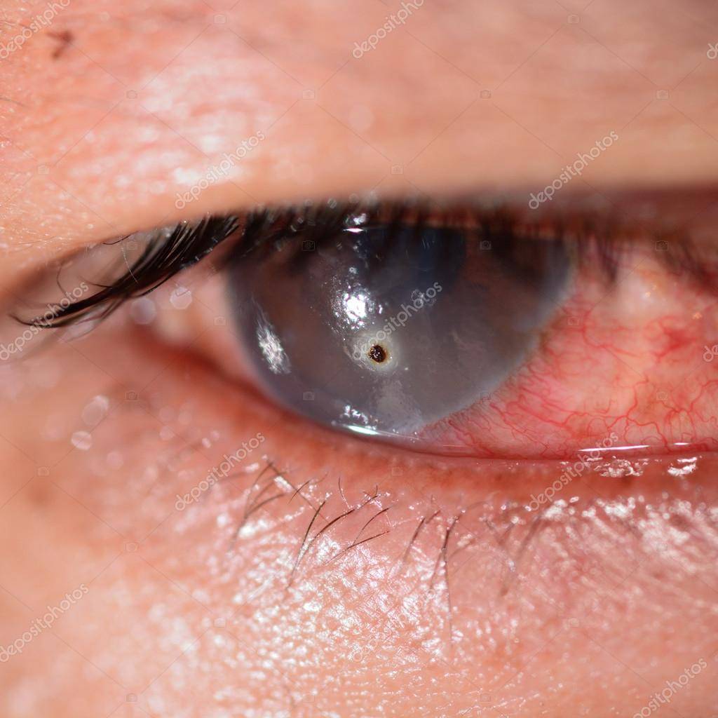 Лечение химических ожогов глаз разной степени и профилактика осложнений