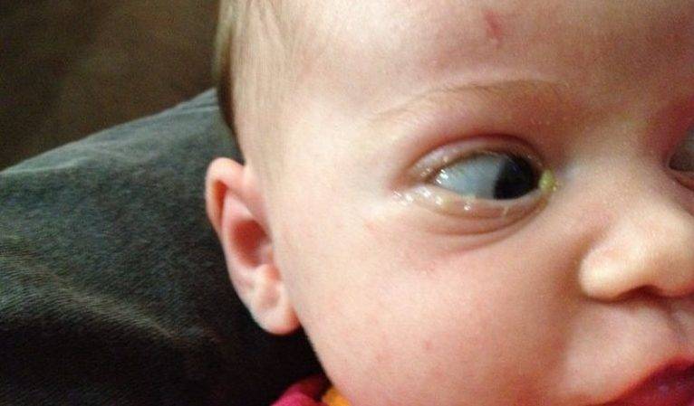 Сильно гноится глаз у новорожденного