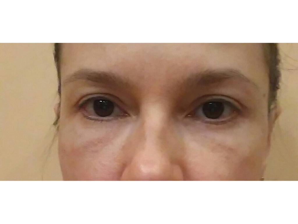 Малярные мешки под глазами: причины, как избавиться от суфов без операции, поможет ли массаж и липолитики, пластическая хирургия в решении проблемы