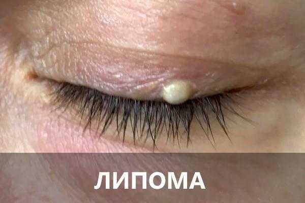 Атерома на лице | компетентно о здоровье на ilive