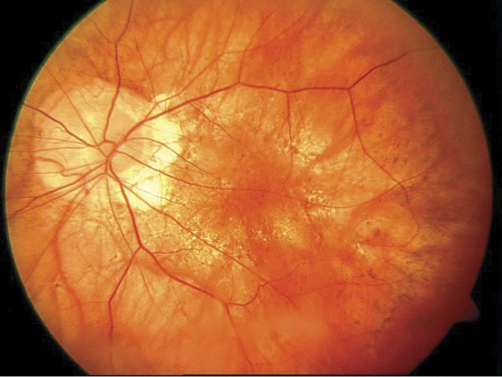 Миопическая стафилома. миопический конус и стафилома — причины и лечение стафилома диска зрительного нерва