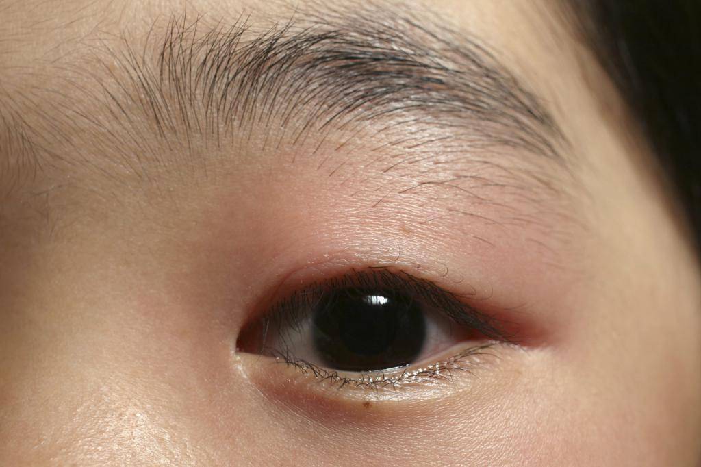 Причины появления, фото и лечение ячменя на глазу