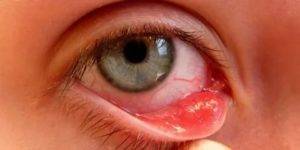 Каким бывает ячмень на глазу – виды и стадии заболевания