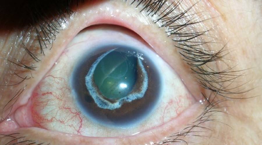 Пузырь на белке глаза - что это, причины и лечение