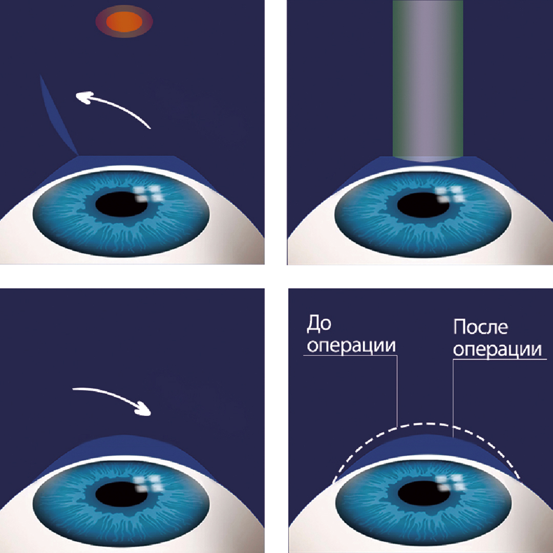 Ограничения и противопоказания после лазерной коррекции зрения