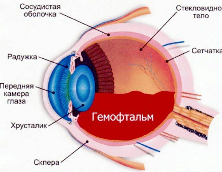 Кровоизлияние в стекловидное тело глаза
