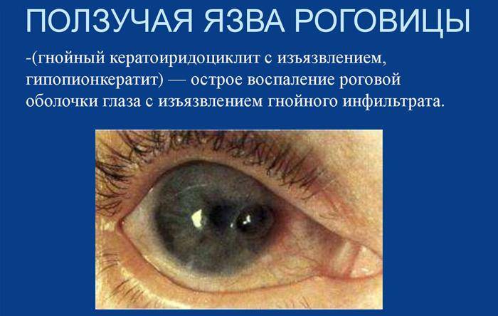 Эндофтальмит и панофтальмит глаза: симптомы, способы лечения
