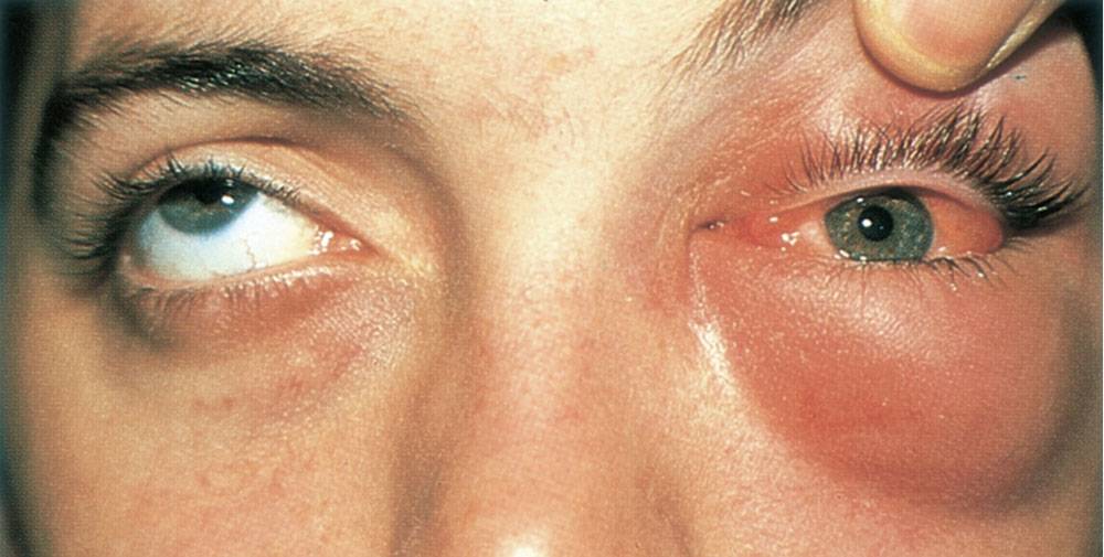 Герпес на глазу (офтальмогерпес) — лечение, симптомы (фото)