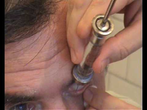 Промывание слезного канала у взрослых - лечение глаз