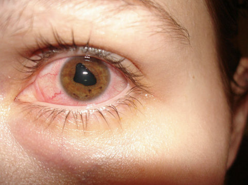 Ирит глаза симптомы – лечение артроза и артрита, лечение подагры