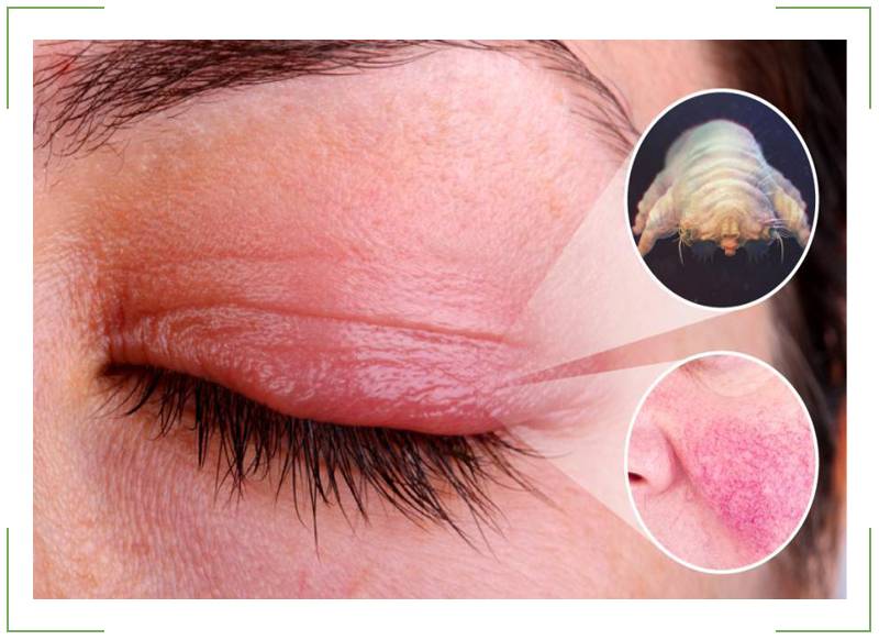 Глазной клещ (демодекс) или ресничный клещ: симптомы и лечение