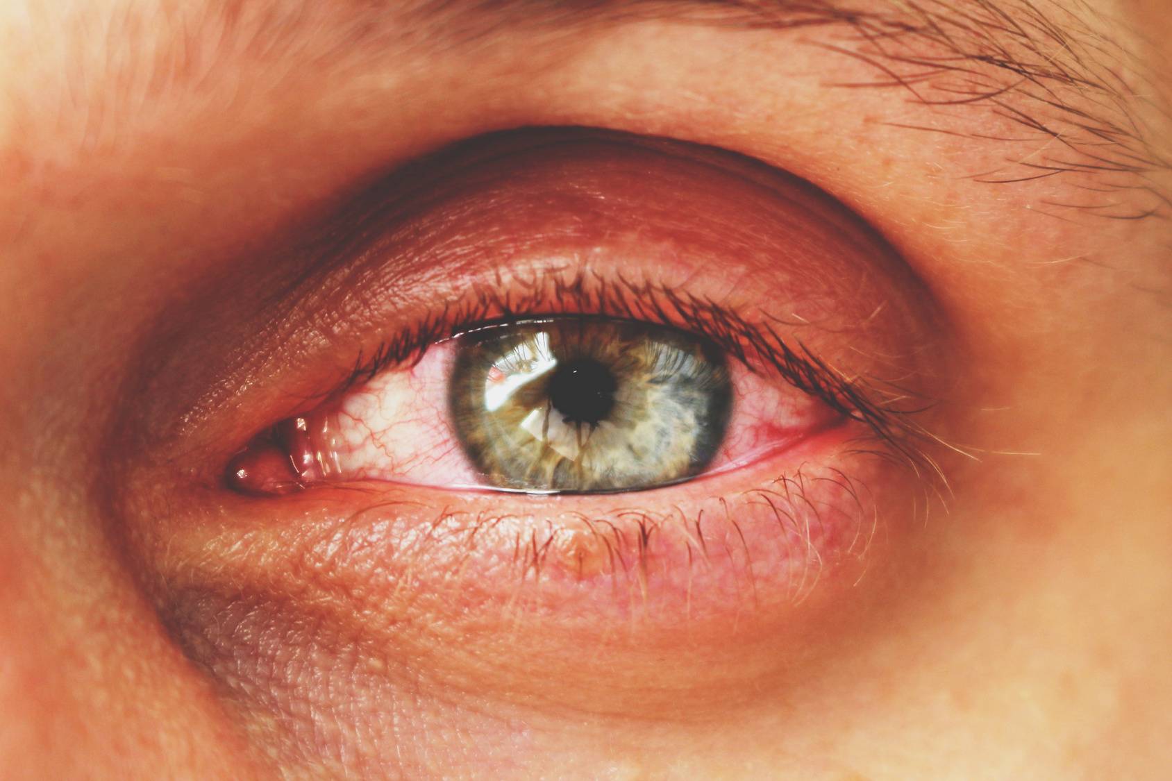 Хламидийный конъюнктивит: симптомы, лечение хламидиоза глаз