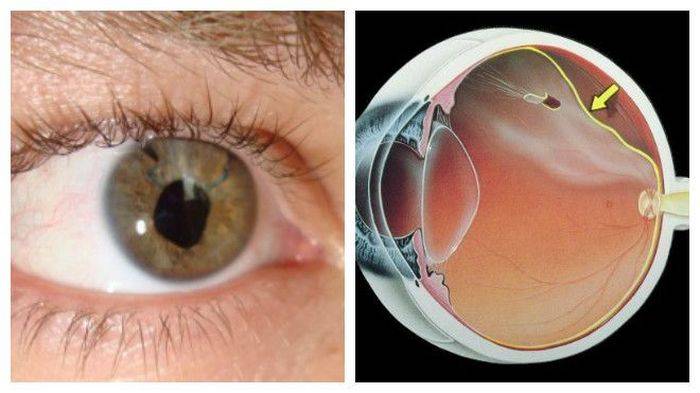 Профилактика и лечение дистрофии сетчатки глаз