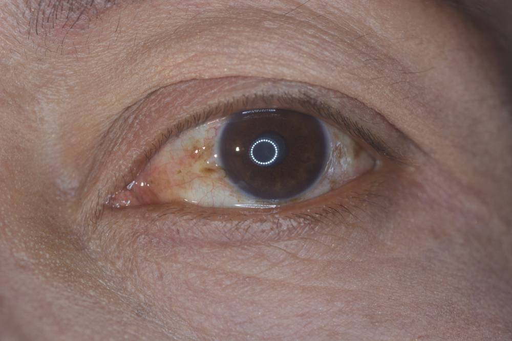 Удаление пингвекулы - глазные капли, как лечить воспаление пингвекулы глаза народными средствами | медицинский портал spacehealth