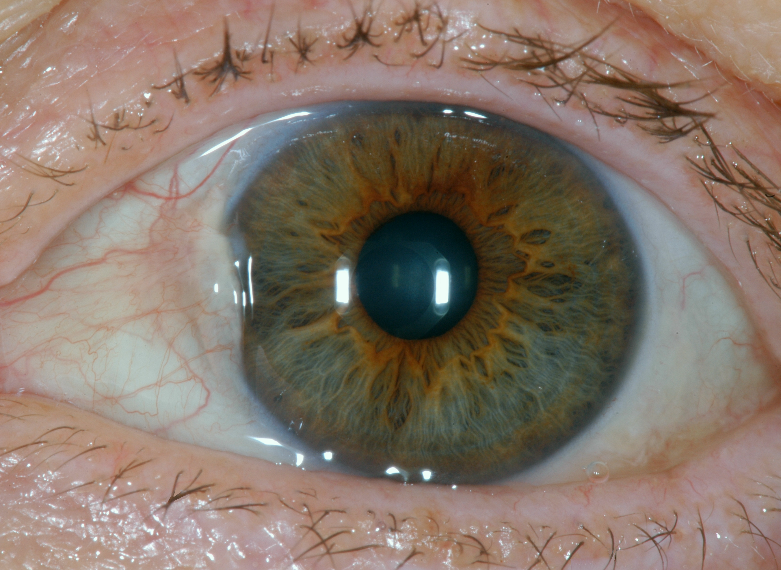 Желтые пятна в глазах - симптомы, признаки и лечение. портал vseozrenii.