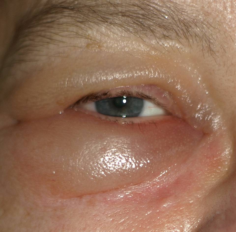 Как лечить простуду глаза в домашних условиях. лечение традиционными методами. как выглядит простуда на глазах