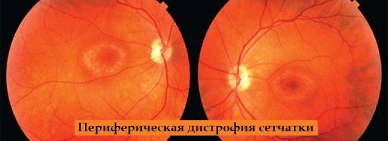 Дистрофия сетчатки глаза: что это такое, как лечить дистрофию глазной сетчатки, фото заболевания