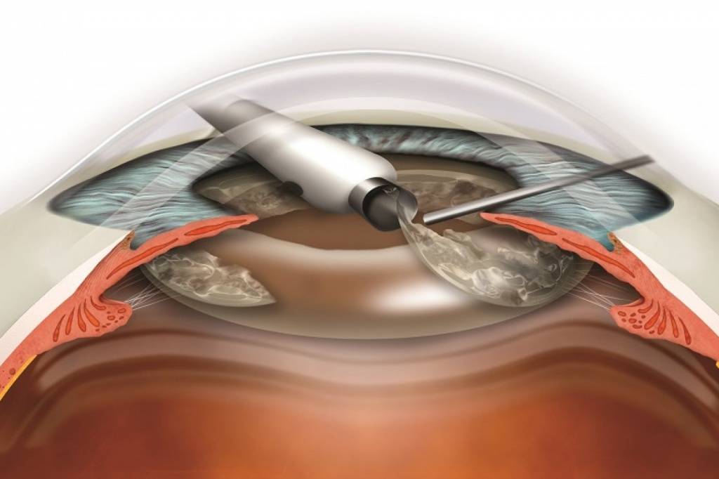 Кому нельзя, или противопоказания к операции по удалению катаракты