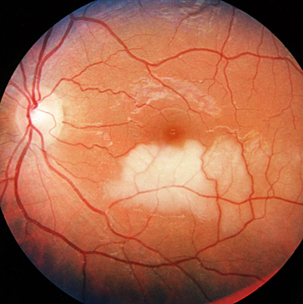Фиброз глаза - что это, симптомы и лечение