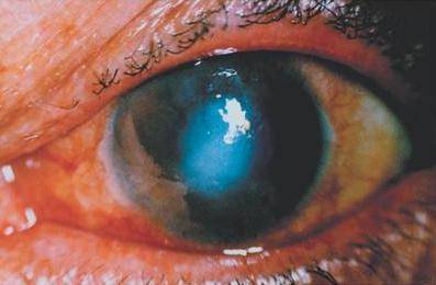Дистрофия роговицы глаза - что это, лечение, причины и симптомы