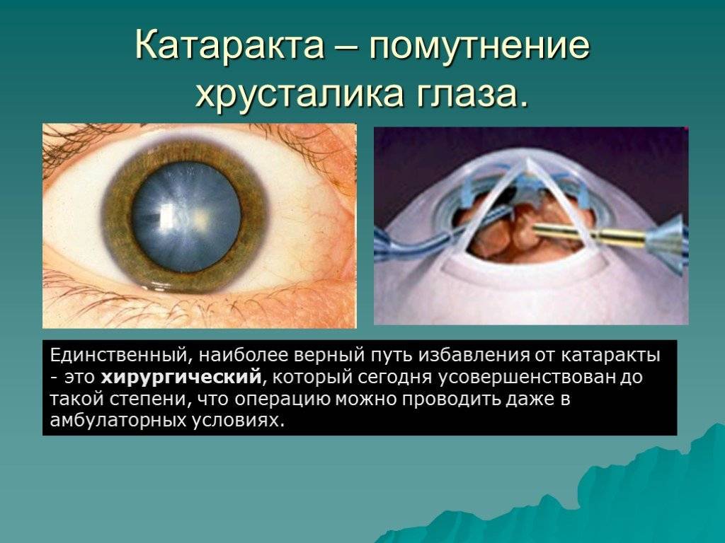 Что такое осложненная катаракта глаз: чем опасна и как ее лечить