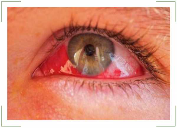 Ожоги глаз: химический, сваркой, термический, ожог роговицы, лечение и первая помощь