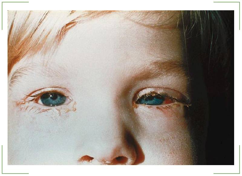 Вирусный конъюнктивит у детей: лечение, как лечить аденовирусный, фото симптомов, капли и препараты для глаз