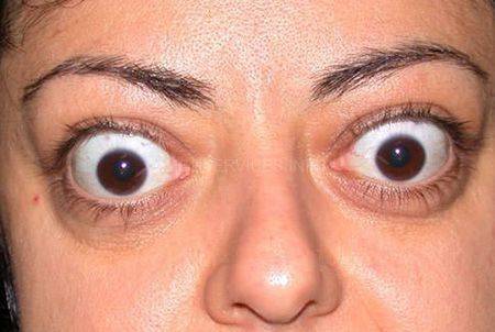 Глаза "вылезают из орбит": пучеглазие (экзофтальм) или физиологическая особенность