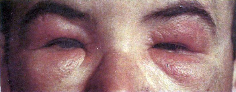 Аллергия вокруг глаз