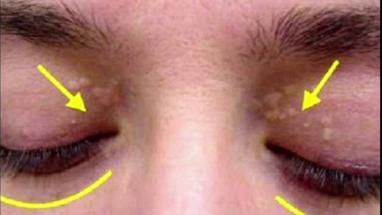 Жировик на веке глаз (верхнем и нижнем): почему появился, как избавиться и убрать быстро, лечение, профилактика