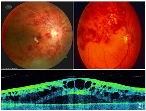 Что такое центральная хориоретинальная дистрофия сетчатки глаза и как она влияет на глаз? — глаза эксперт