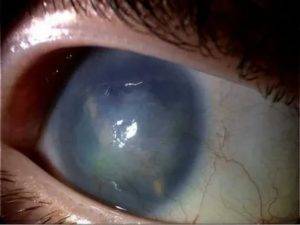 Симптомы глаукомы на ранних стадиях: лечение, профилактика, открытоугольная, закрытоугольная, приступ, в домашних условиях