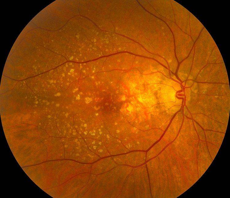 Дегенерация сетчатки глаза: что это такое, симптомы, причины, лечение oculistic.ru
дегенерация сетчатки глаза: что это такое, симптомы, причины, лечение