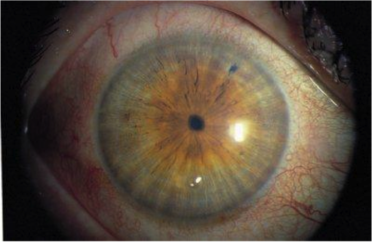 Миоз: виды, симптомы и лечение и что это - "здоровое око"