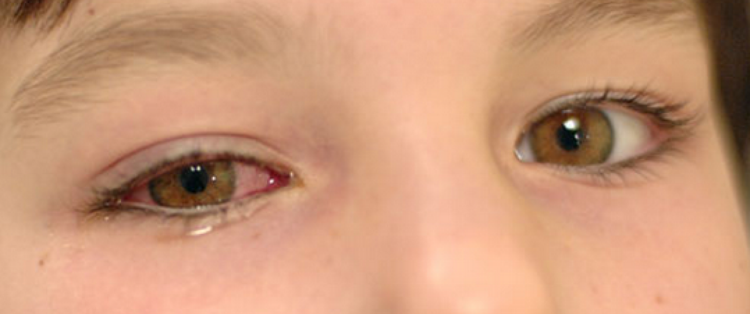 Покраснение глаз у ребенка. причины и лечение при простуде, орви, температуре, аллергии. капли, народные средства, что советует комаровский